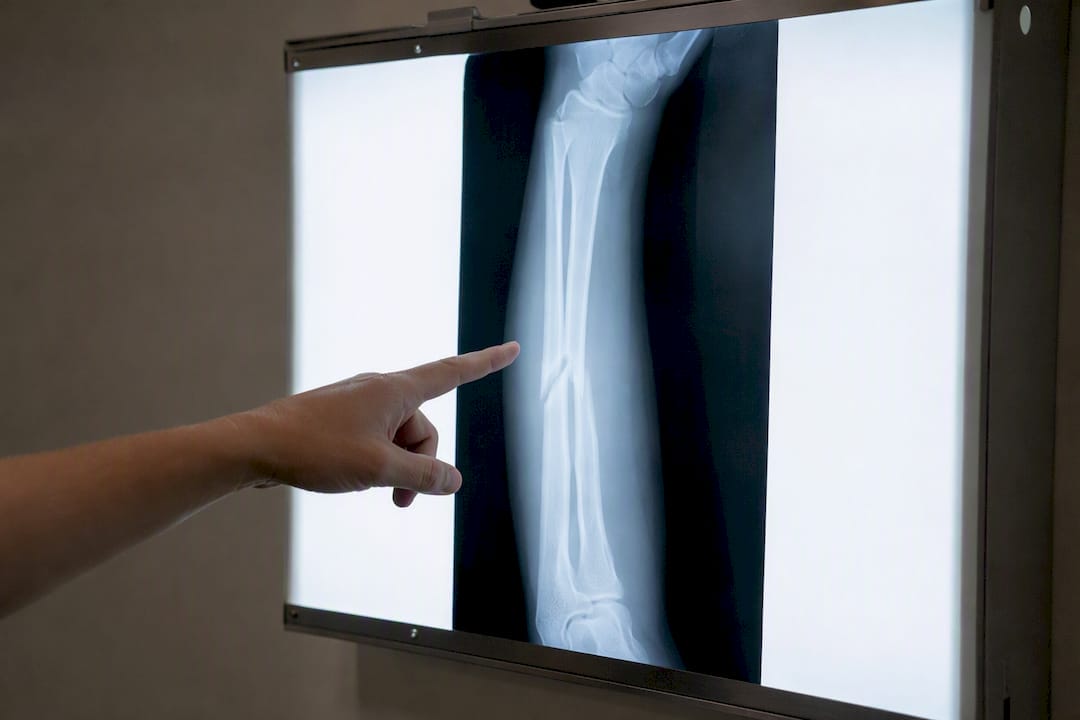 Document Injuries Immediately to Protect Your Health and Claim X-ray image of arm fracture on medical screen